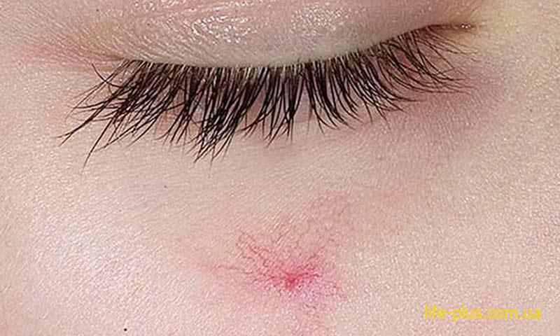 судинна сіточка на обличчі