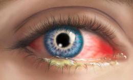 Здоров'я Почервоніння очей