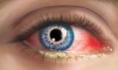 Почервоніння очей