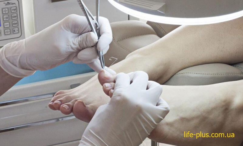 ingrown toenail treatment